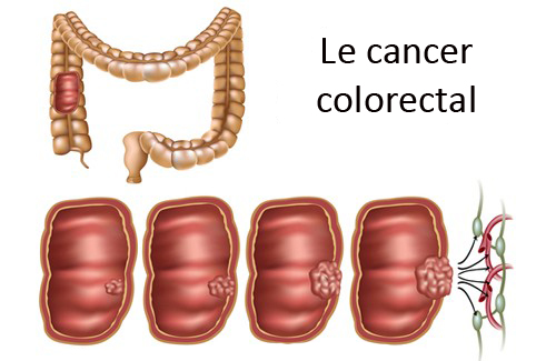 Comment reconnaître et prévenir le cancer colorectal ?