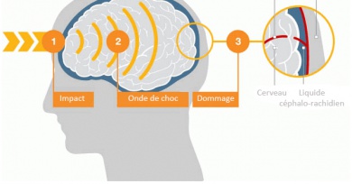 Quel impact ont les coups sur la tête ?