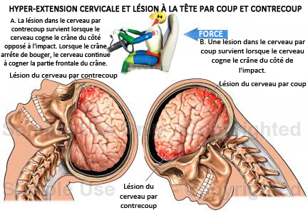 impact ont les coups sur la tête : mémoire et apprentissage
