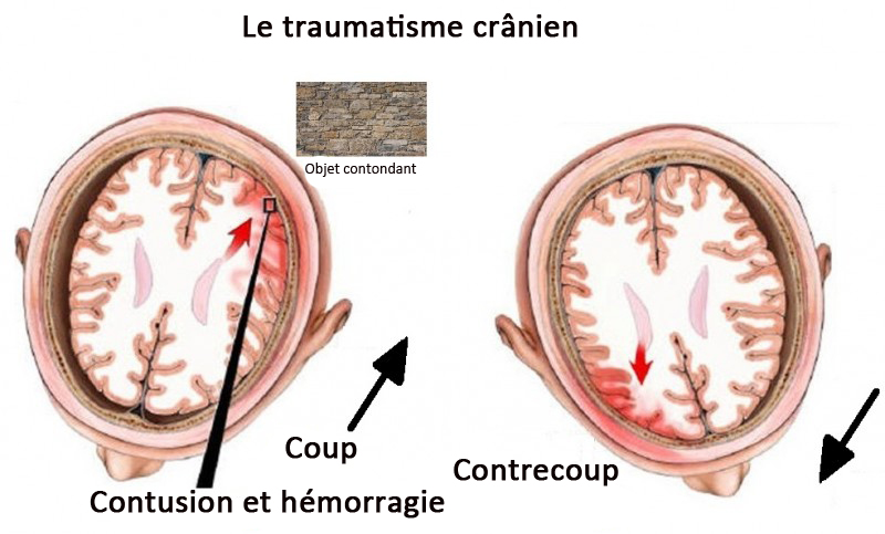impact ont les coups sur la tête : traumatisme cranien