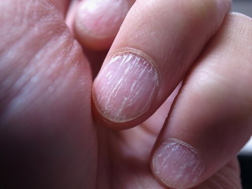 Remèdes maison contre les champignons des ongles
