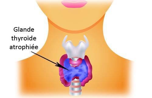 L'hypothyroïdie : comment prendre soin de sa thyroïde