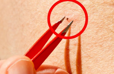 Les tiques... un danger pour l'homme et les animaux