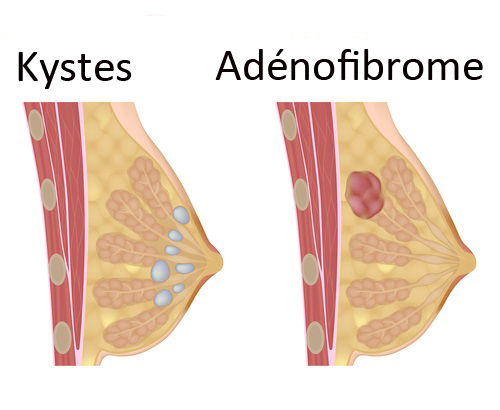seins kystes adénofibrome