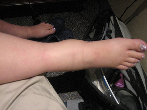 inflammation des chevilles