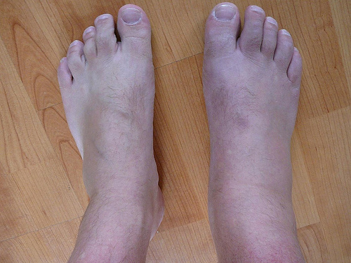 inflammation des chevilles