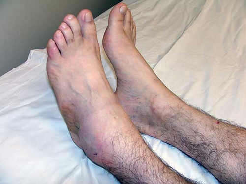 inflammation des chevilles