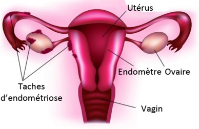 Les principaux symptômes de l'endométriose