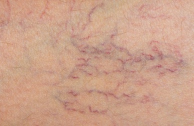 Le marronnier d'Inde, un allié contre les varices !