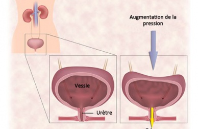 Les exercices contre l'incontinence urinaire chez les femmes