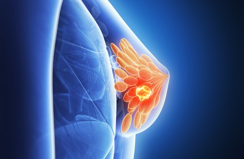 Peut-on prédire le cancer du sein ?