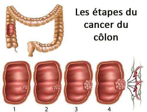 Soigner un cancer du côlon.