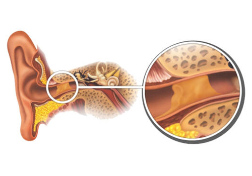 comment bien se nettoyer les oreilles