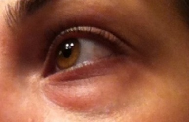 Vous avez des cernes ? Faites-les disparaître de façon naturelle !