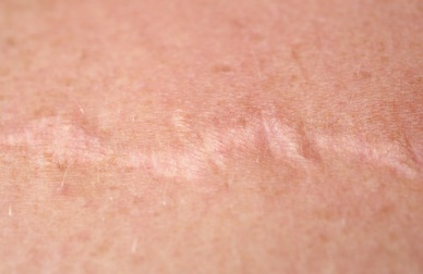 Comment utiliser l'oignon pour traiter les cicatrices