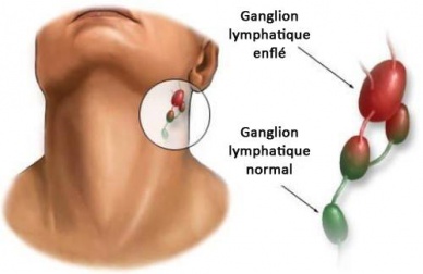 Causes de l'inflammation des ganglions lymphatiques