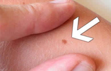 Comment reconnaît-on les grains de beauté suspects ?
