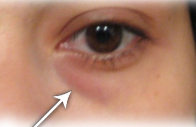 Des remèdes maison contre les cernes