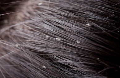 Des remèdes maison efficaces pour combattre les pellicules