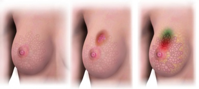 4 tumeurs sur 10 peuvent être évitées !