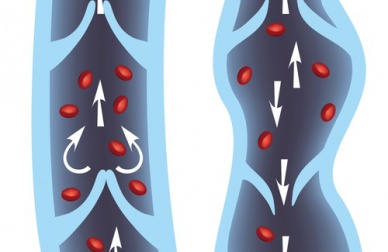 Traitement des varices : les 10 meilleurs remèdes