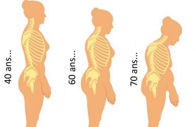 L’arthrose : une maladie très commune