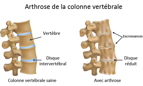 l’arthrose