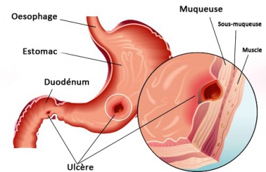Le traitement naturel contre les ulcères gastriques