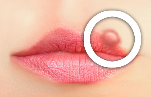 Comment prévenir les boutons de fièvre