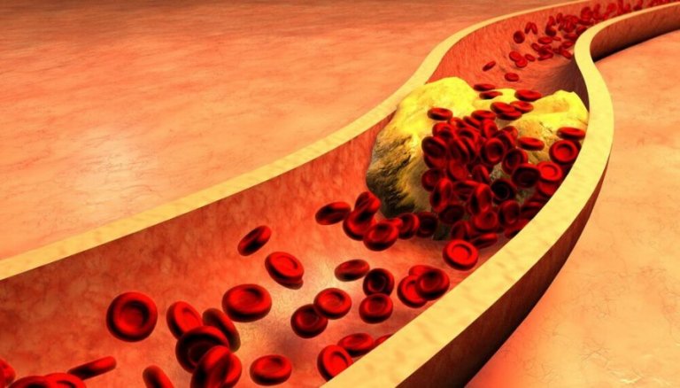 Comment déboucher les artères obstruées ?
