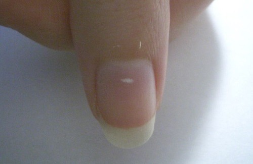 Que signifient les taches blanches sous les ongles ?