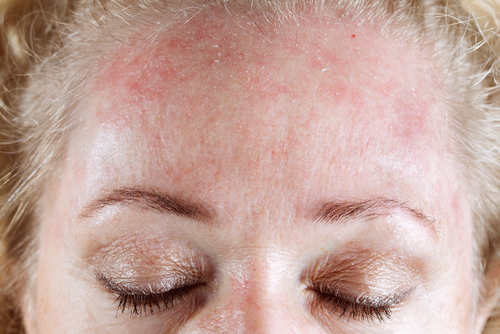 allergies cutanées