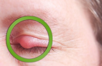 Comment guérir un orgelet rapidement ?