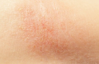 Des remèdes naturels pour traiter les peaux sèches