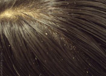 Des remèdes naturels pour combattre les pellicules