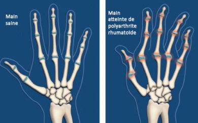 L'arthrite : 6 mesures à prendre qui vous soulageront