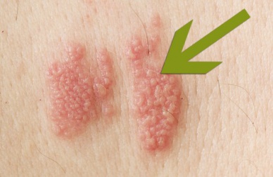 Le zona : de quoi s'agit-il ? Comment se manifeste-t-il ?