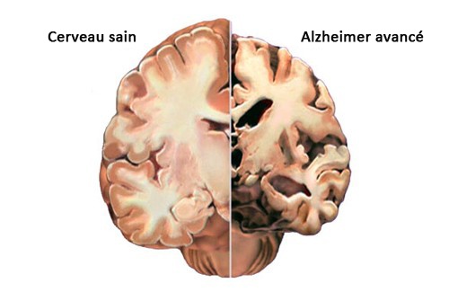 Alzheimer : comment détecter les premiers symptômes ?
