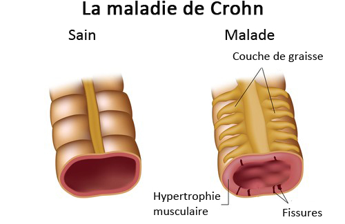 La maladie de Crohn : symptômes et traitement
