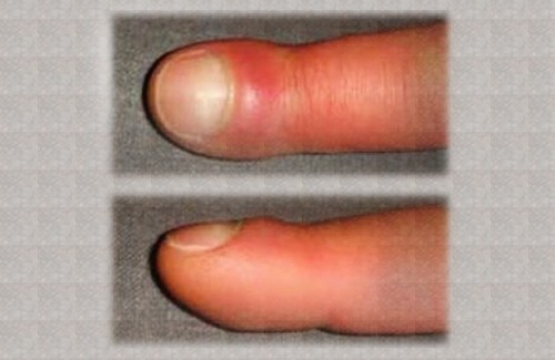 Herpes on Finger with Pictures | Herpes Land
