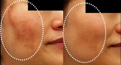 Le traitement du mélasma avec des remèdes naturels