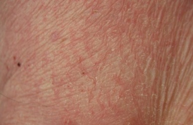 Les aliments et les compléments pour la peau sèche et terne