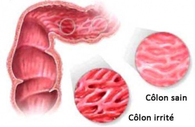 Des infusions pour traiter le syndrome du côlon irritable