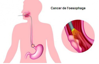 Les symptômes des principales maladies de l'œsophage