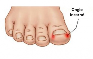 Comment éviter d'avoir les ongles incarnés ?