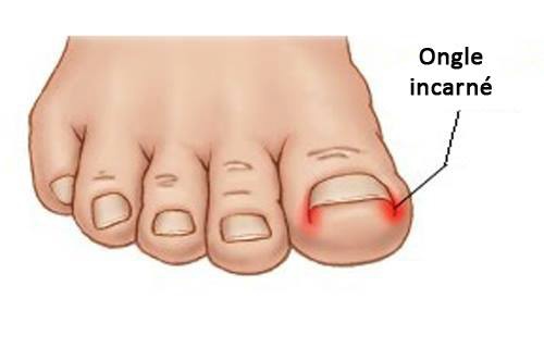 Ongle incarné