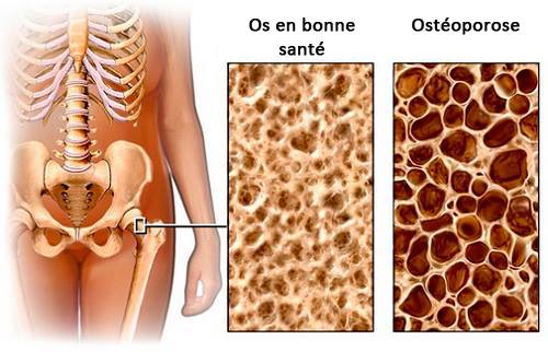 Une diète à observer pour éviter l'ostéoporose