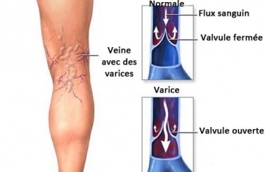 Des moyens pour soulager les douleurs des varices