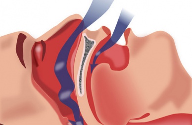 Comment traiter l’apnée du sommeil ?
