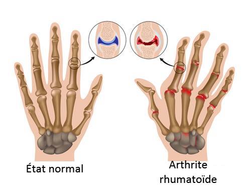 L’arthrite rhumatoïde : comment en contrôler les symptômes ?
